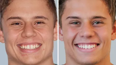 spark-aligners-before-after-results.jpg spark-aligners-before-after-results